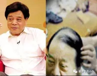 赵忠祥竟是戴了30年的假发,摘掉后头发是这样,肾虚易导致秃顶