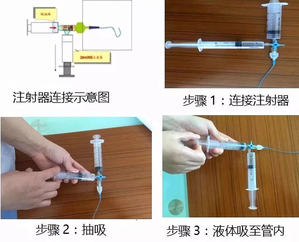 探讨不同尿激酶用量经导管溶栓治疗的下肢深静脉血栓形成患者的疗效