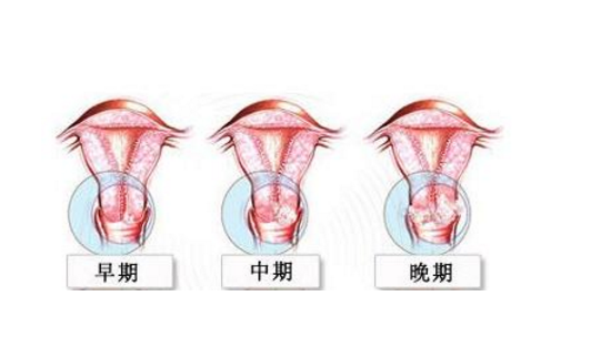 有时排液可夹杂癌组织的小碎片.倘若宫颈腔积脓,引起发烧,腹痛