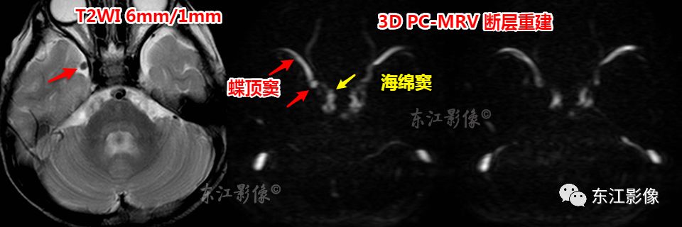 右侧蝶顶窦起始部折曲,容易误认为异常.