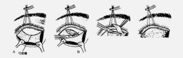 使凹陷平整,修复加强眶隔筋膜,悬吊松弛的眼轮匝肌到眶骨骨膜上,然后