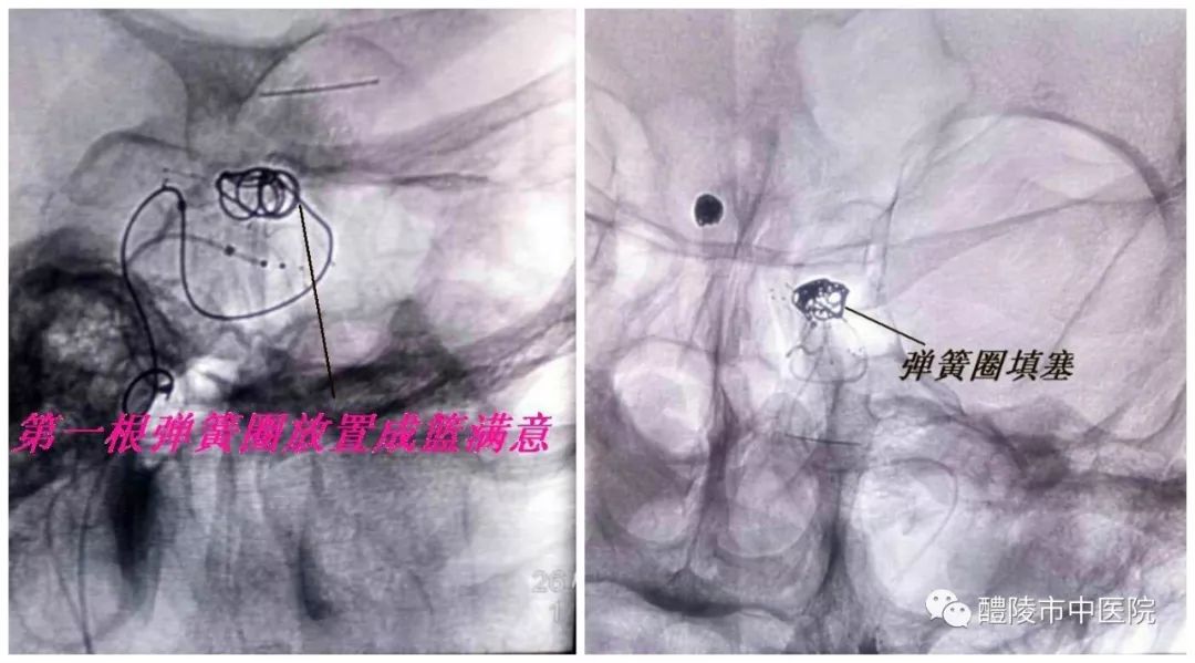 市中医院成功开展颅内动脉瘤介入栓塞术
