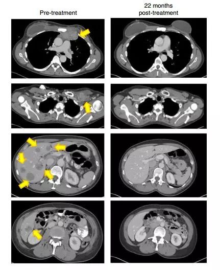 (下图的左列是之前的影响学检查结果,右侧一列是之后的影像学结果.