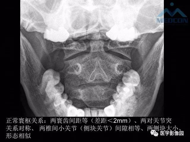 寰枢关节脱位的影像诊断寰枢关节脱位或称为寰,枢椎脱位,是指颈椎的