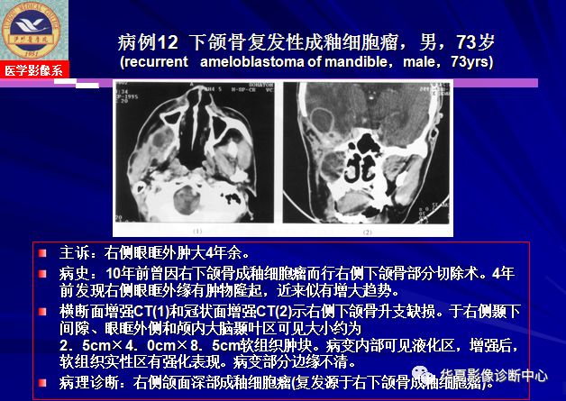 成釉细胞瘤的影像特点与病例分析