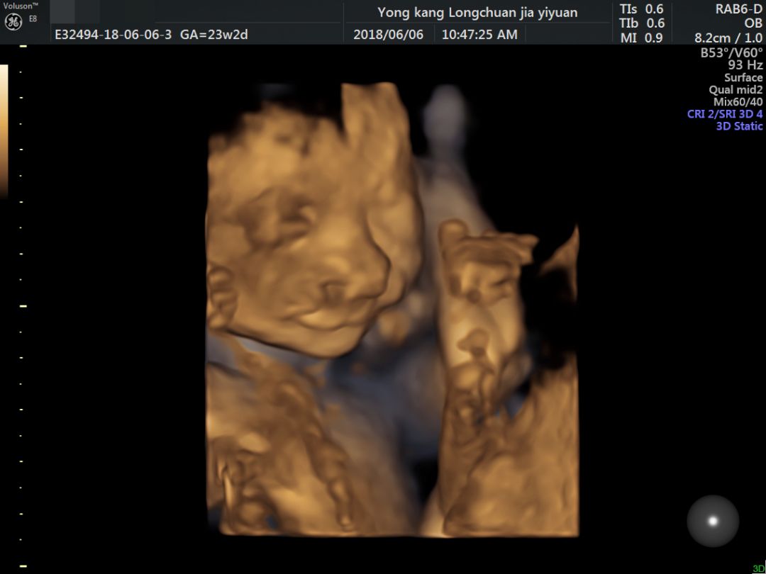 孕22周,检查的时间到了,一番检查后,超声医生黄晓霞告知小丽,胎儿上唇