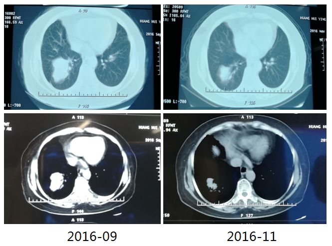爱肺月月评 | 第35期:一例晚期NSCLC EGFR-T