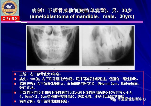 成釉细胞瘤的影像特点与病例分析