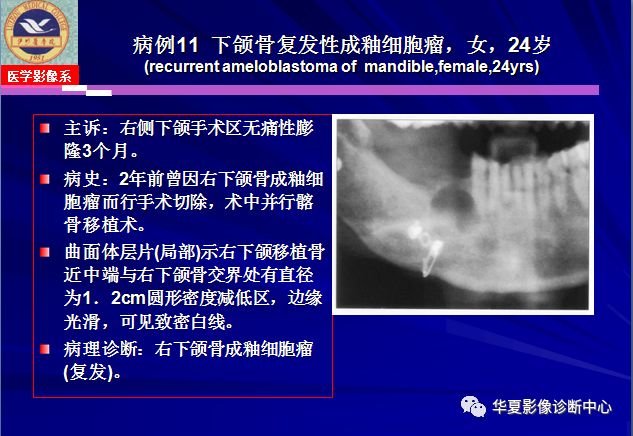 成釉细胞瘤的影像特点与病例分析