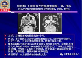 成釉细胞瘤的影像特点与病例分析