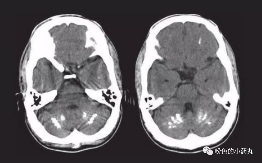 dentate nuclei ofcerebellum(小脑齿状核)