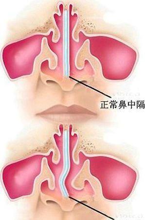 健康|小鼻子 大健康——鼻科疾病概述