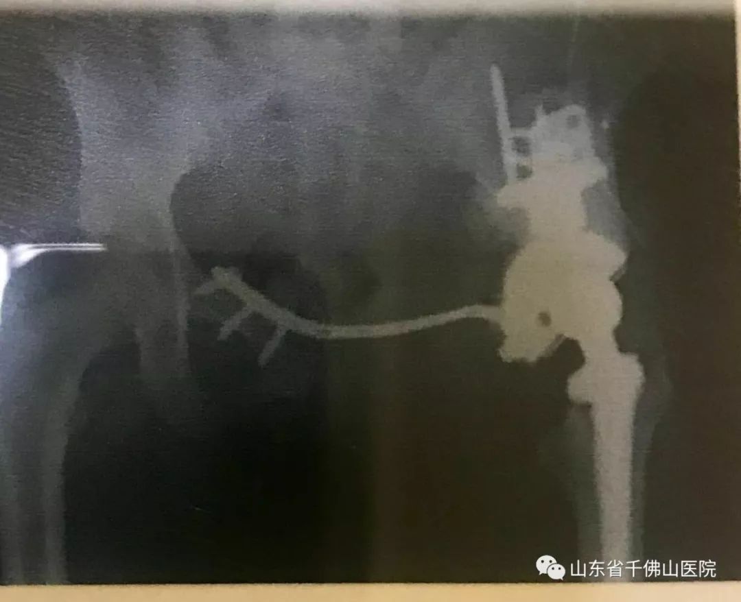 省千医首例3d打印半骨盆假体置换术日前成功实施