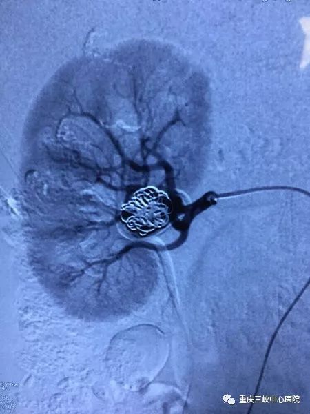外科成功为一名60岁女性患者在局麻dsa下行右肾动脉造影 动脉瘤栓塞术