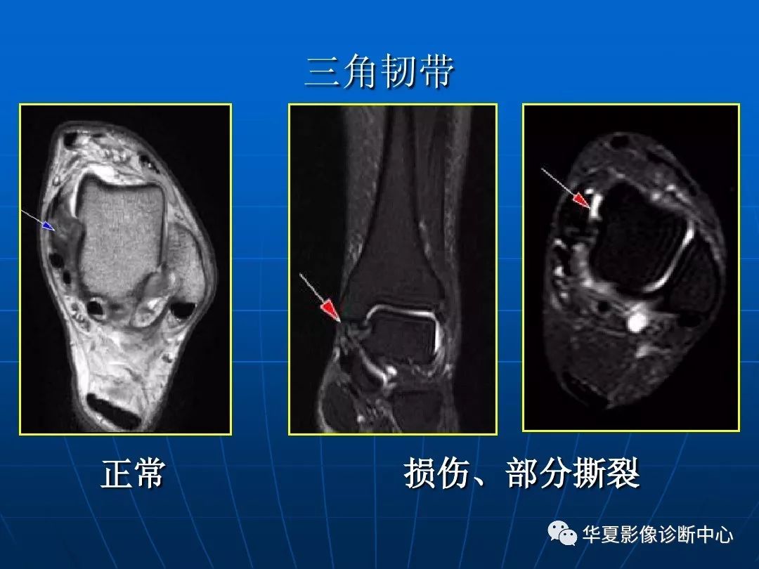 踝关节损伤的磁共振扫描技术及诊断