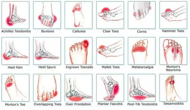 脚部的各种疼痛,你经历过哪些?