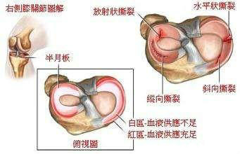 半月板手术后遗症