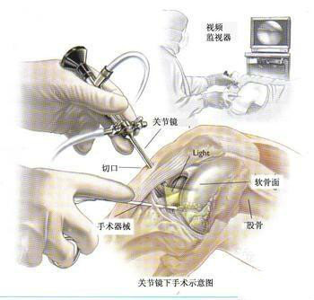 半月板手术后遗症