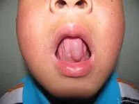 腺囊肿是发生在舌前腺的黏液囊肿,是一种良性病变,多发于青少年与儿童