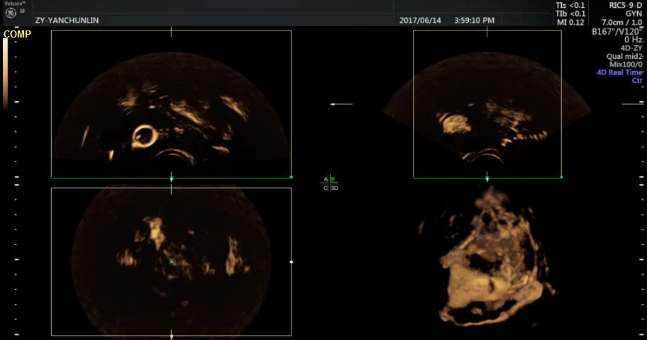 生殖超声检查全知道