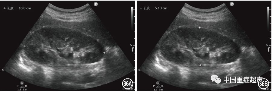 将超声探头沿肾脏长轴呈冠状位扫描,获取肾脏最大切面,测量肾脏上下