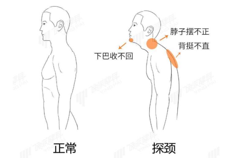 发现高女士圆肩弓背头前探,肩胛骨前移,肱骨前移,胸小肌过紧,整个