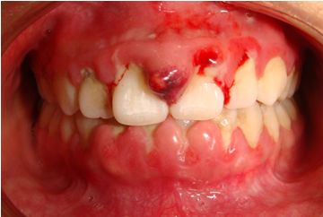 口腔卫生不佳,牙龈发生炎症病变时,牙龈颜色会呈现不健康的深红或暗红