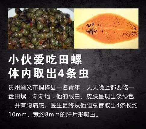 身体里取出3条活虫,医生都吓一跳!原来她从小爱喝