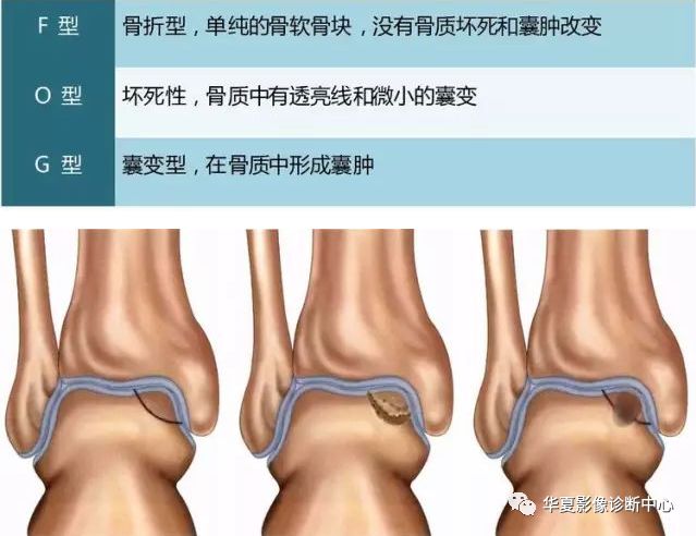 【影像拾遗】距骨软骨损伤分型