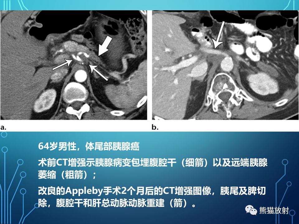 胰腺癌丨肿瘤与血管的关系丨ct表现