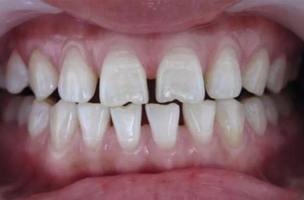 使四个门牙散开,使用牙齿矫正借住外力使牙齿靠拢,缩小牙缝间隙