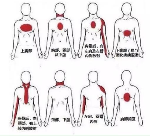 心脏病放射性疼痛常见部位