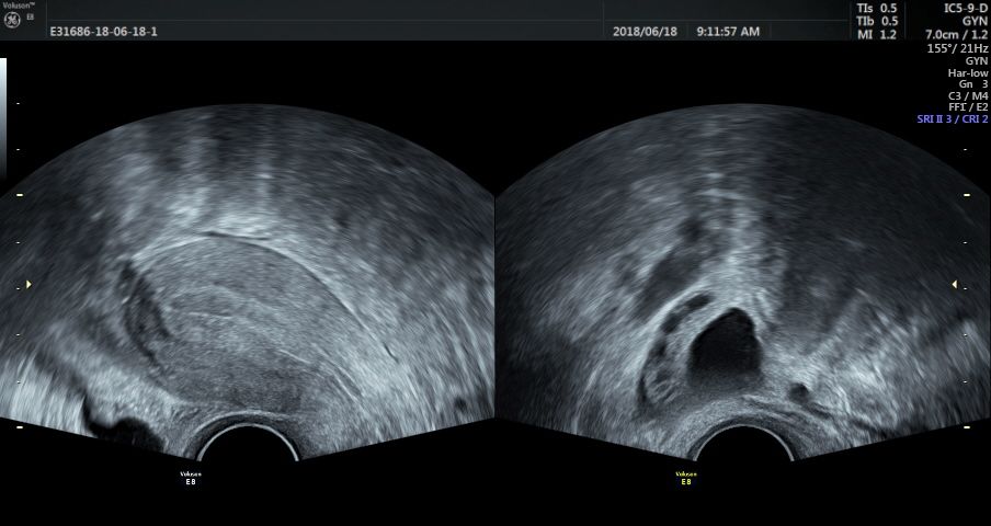 生殖超声检查全知道