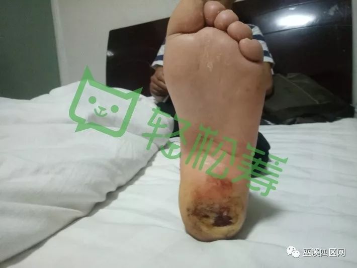 残缺身体面临截肢请救救他的腿