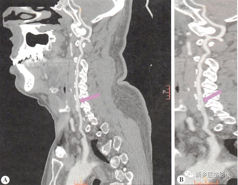脑静脉窦血栓和颈动脉夹层ct分析