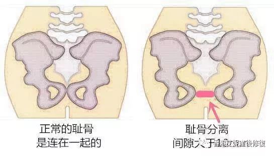 产后骨盆修复有必要吗这些问题你知道吗