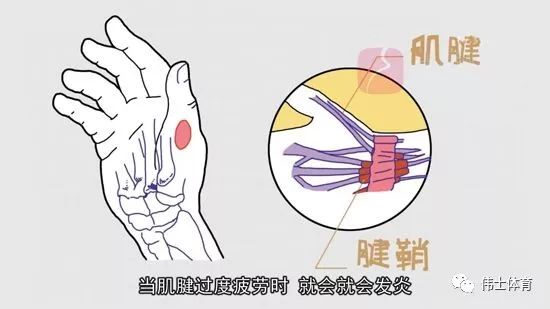在手腕的受伤类型中,有一种叫做腱鞘炎的症状,那么腱鞘炎具体是怎样