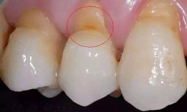 健康 正文  牙釉质发育不全的牙齿,牙釉质形成的量会减少, 比一般的