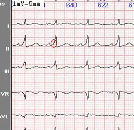 治疗心梗的药 预激综合征心电图4