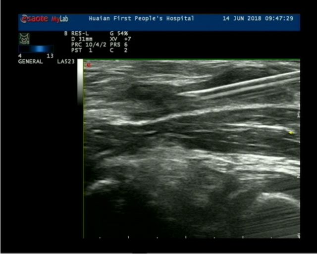 小针办大事市一院介入超声科运用肌骨超声治疗腘窝囊肿