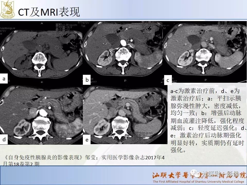 自身免疫性胰腺炎ct及mri特征