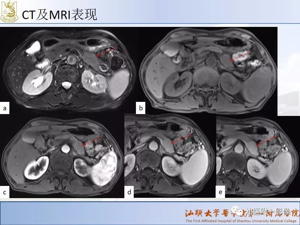 自身免疫性胰腺炎ct及mri特征