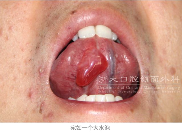 向左滑动可查看舌前腺黏液囊肿图片
