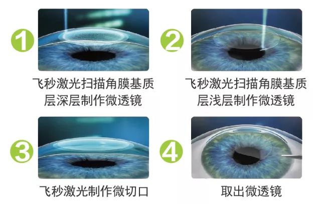 全飞秒近视手术的原理_全飞秒