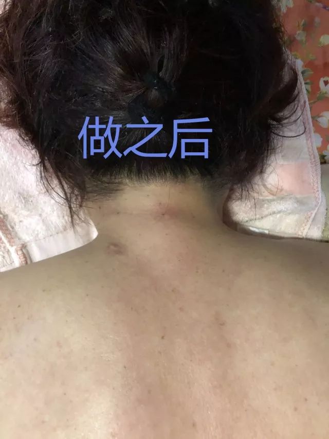 颈后长"富贵包"不富贵!这个大包其实很危险.