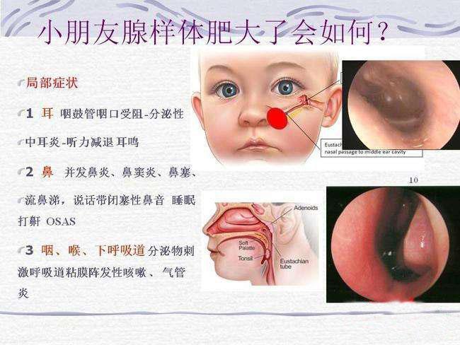 由于儿童发育需要大量的氧,而腺样体肥大会使孩子在睡眠中严重缺氧