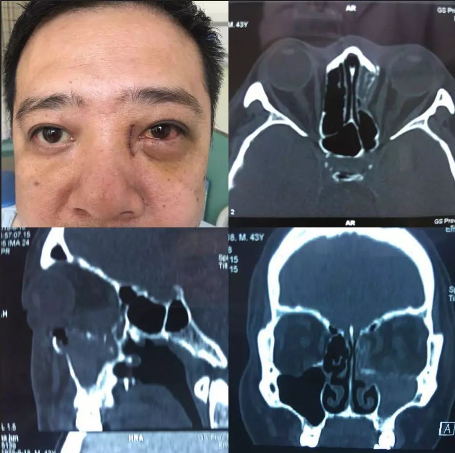 男,43岁,因"左眼外伤45天,发现眼球内陷10天"门诊以"左侧眼眶骨折"于