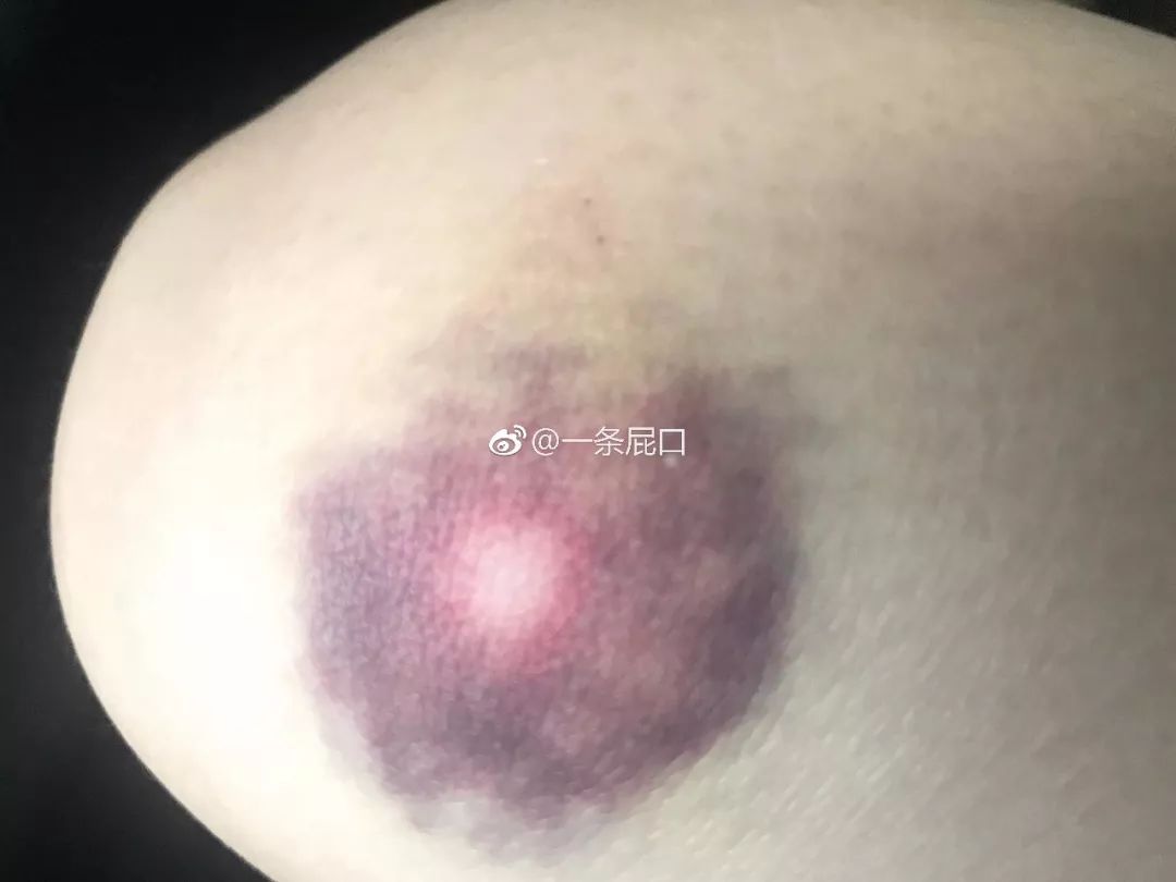 前几日,网友@一条屁口在微博上po出一张自己的膝盖被撞出淤血,接着