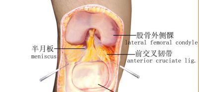 水针刀疗法配合玻璃酸钠针治疗膝骨性关节炎的临床研究