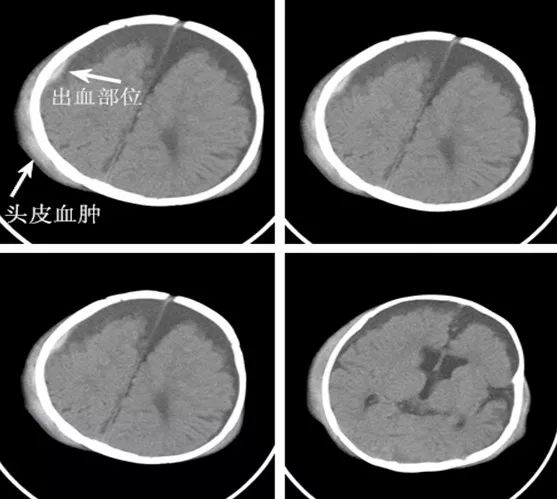 头颅肿大 急诊ct显示 小宝宝颅骨多处骨折 颅内出血 广泛性头皮血肿